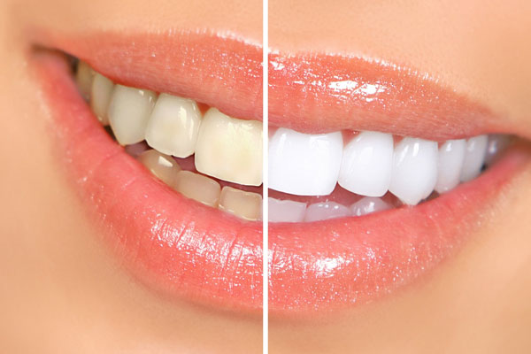 Cyprus Teeth Whitening