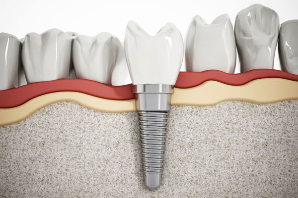 cyprus dental implant